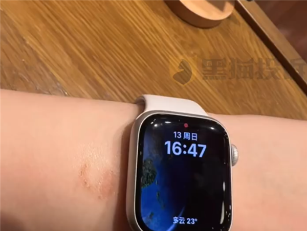 女子戴Apple Watch睡覺被燙傷起泡 蘋果客服回應：過敏反應