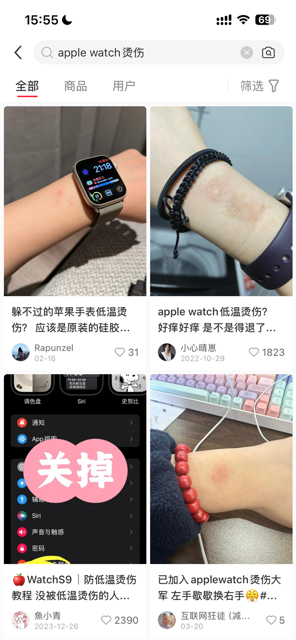 女子戴Apple Watch睡覺被燙傷起泡 蘋果客服回應：過敏反應